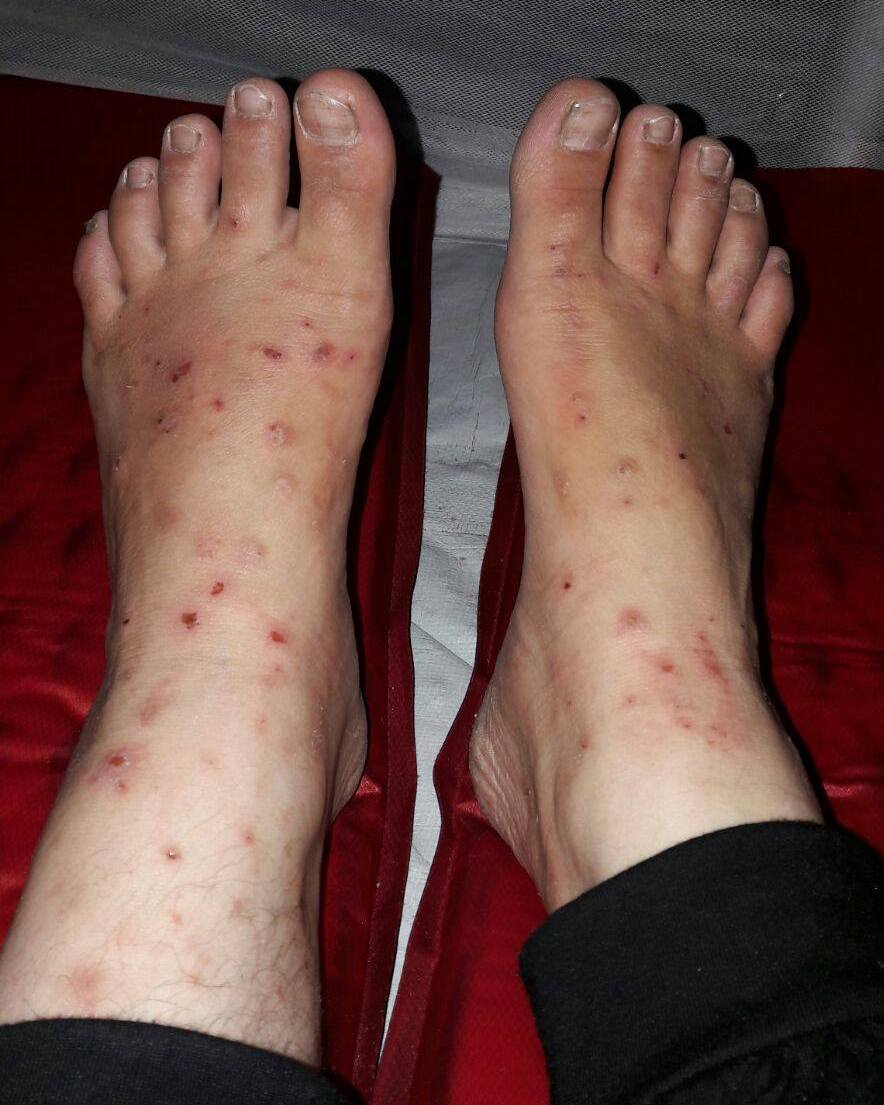 22-wifes-mosquito-bites1